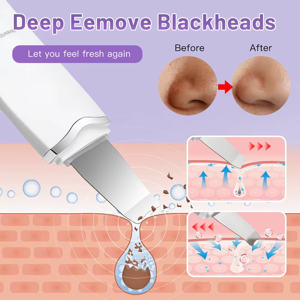 Espátula Ultrasónica De Limpieza Facial